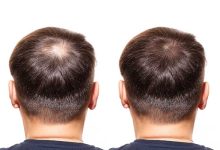 8 بهترین مواد احیای مو برای مردان (ایرانی و خارجی)