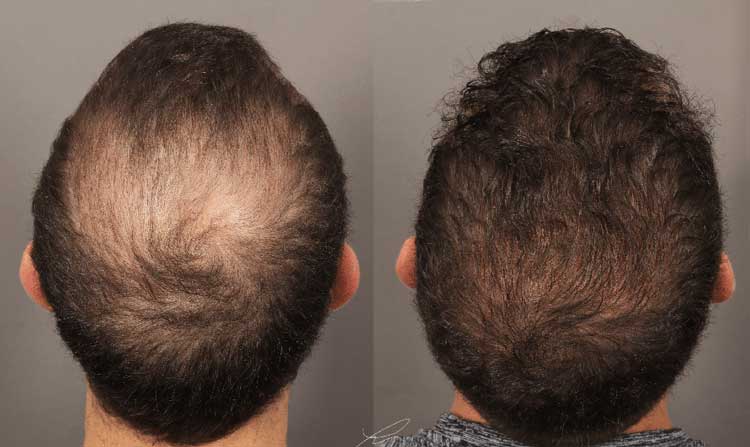 تقویت مو | مراقبت مو